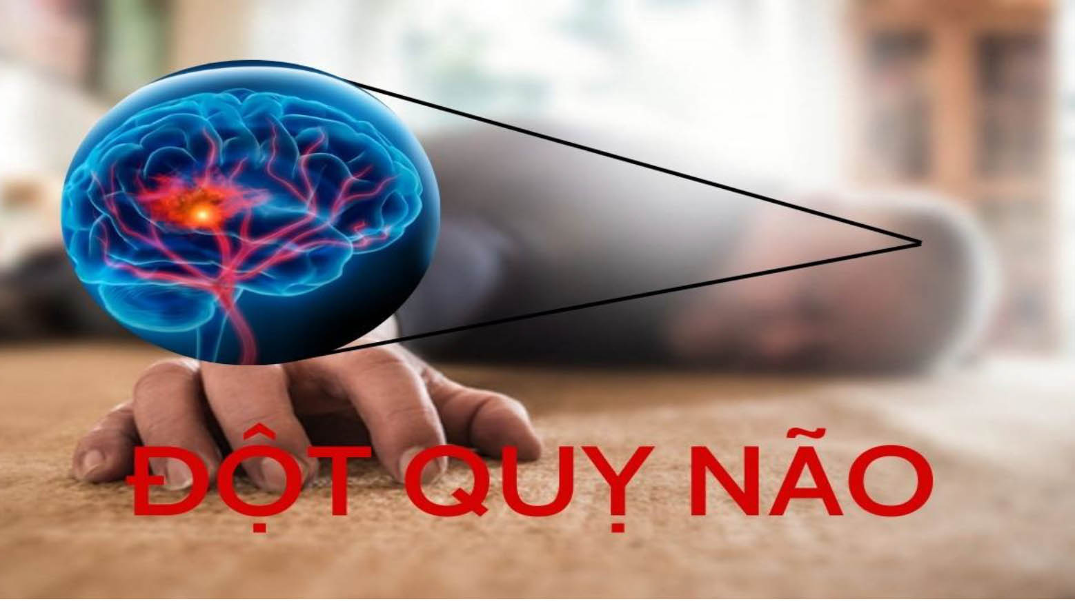 Đột quỵ: Khi thời gian được tính bằng số tế bào não của người bệnh